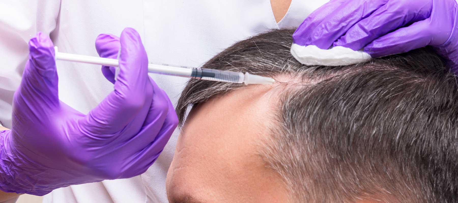 Injection de PRP pour les cheveux à la Maison de la greffe Capillaire à Paris